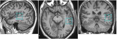 No Effects of Anodal tDCS on Local GABA and Glx Levels in the Left Posterior Superior Temporal Gyrus